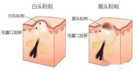 中性与油性皮肤测定及护理方法
