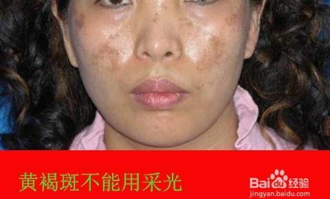 光子嫩肤祛斑的危害/采光(e光)去雀斑副作用