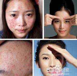 如何避免眉心长痘痘,日常护肤应该注意什么?