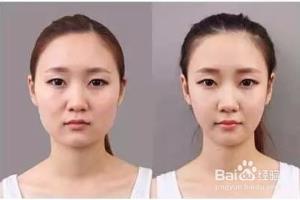 怎样瘦脸更加快速？.