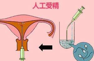 哪些人适合做人工授精