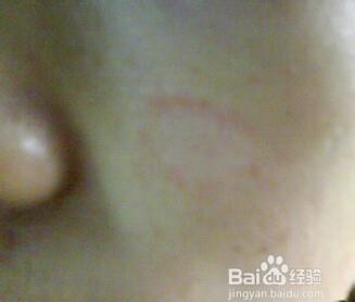 脸上长癣怎么办小孩脸上起皮干燥有点白