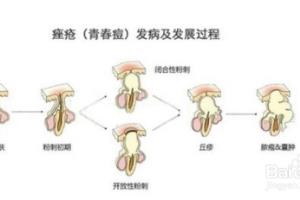 治痤疮的有效方法.