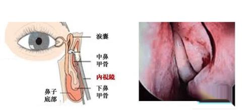 鼻甲被切除了怎么办