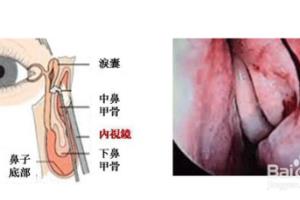鼻甲被切除了怎么办.