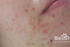 女性长青春痘该肿么办呢？.