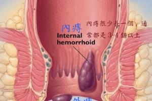 如何利用食疗偏方根治痔疮？.