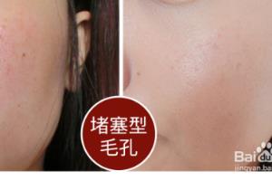如何收缩毛孔的方法.