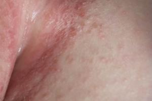 新生儿湿疹正确处理经验分享.