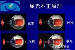 球后视神经炎鉴别诊断.