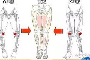 如何纠正腿型？.