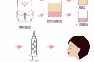 【自体脂肪面雕】一次解决两大难题！.