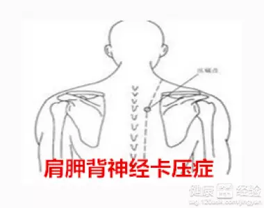 左肩膀后面肩胛骨缝隙处疼痛怎么办(1)
