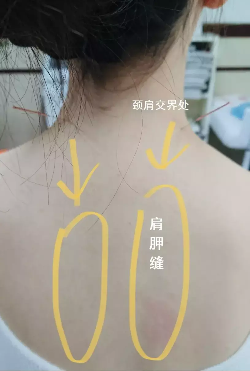 左肩膀后面肩胛骨缝隙处疼痛怎么办(3)