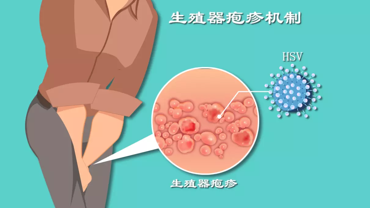 女生那里长了一个疙瘩是怎么回事(4)