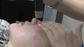 像素激光除皱会使面部皮肤变薄吗(1)