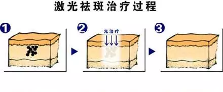 像素激光除皱会使面部皮肤变薄吗(3)