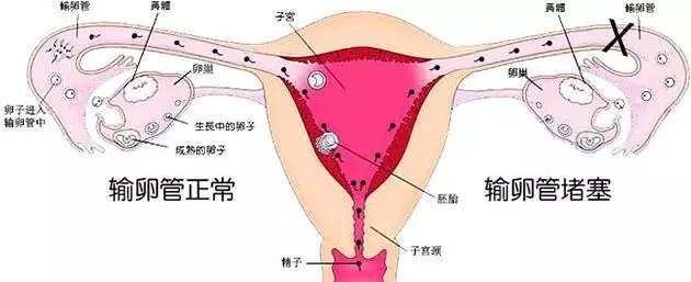 输卵管和卵巢的位置图(3)