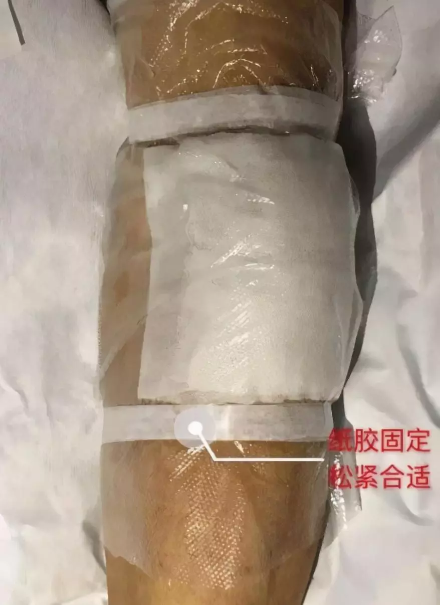 输液手肿了怎样快速消肿 土豆片(3)