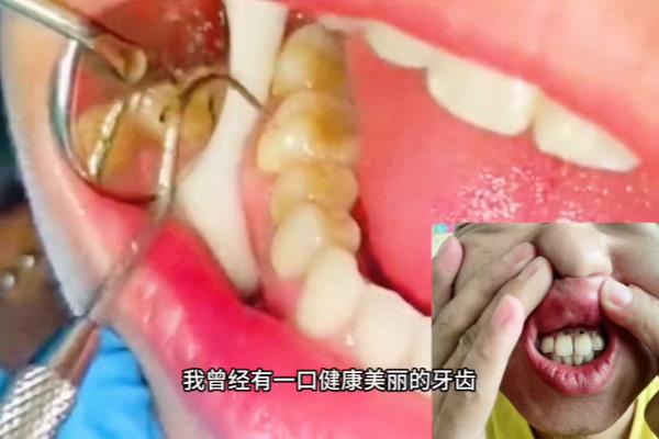 牙齿腐蚀修复价格掉一颗价格.