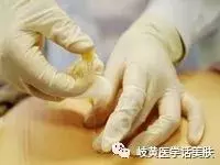 中医埋线疗法的作用及副作用(5)