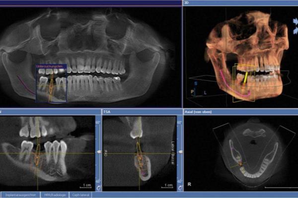 cbct和全景片的区别.