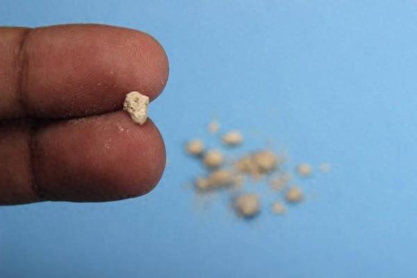 肾结石5mm激光碎石费用.