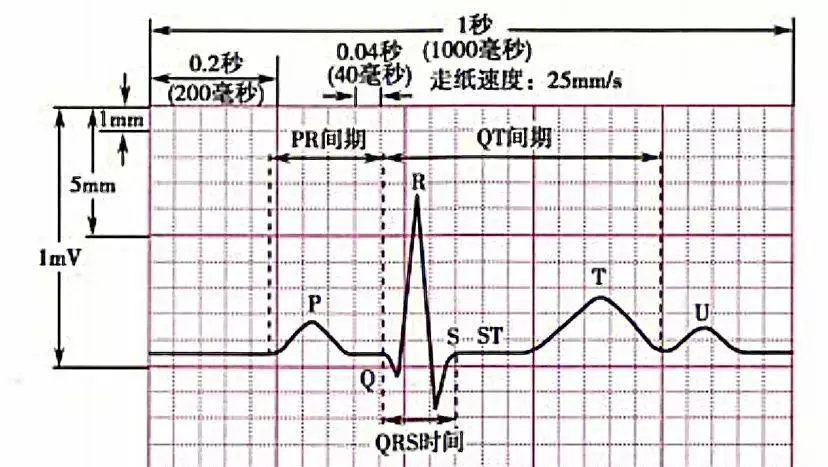 肢体导联QRS波低电压是什么意思(4)